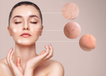 Healing Breakouts Naturally: Organic Solutions for Acne & Blemishes