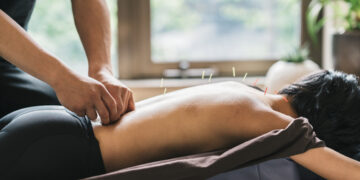 Getting Started with Acupuncture: What to Expect & Potential Benefits